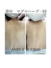 アネラ(ANELA)/エルモサハーブ　　症例　背中