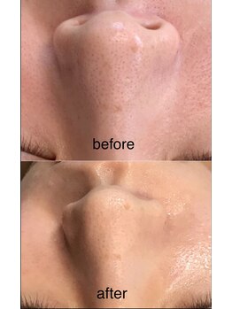 コウベ美容鍼灸治療院(KOBE美容鍼灸治療院)/毛穴施術２ハイドロフェイシャル