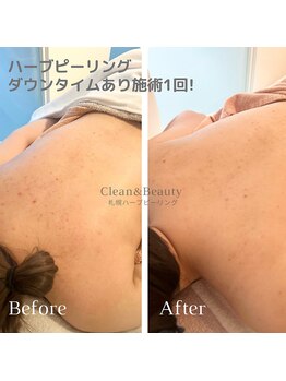 クリーンアンドビューティ 札幌(Clean&Beauty)/背中ケアもハーブピーリング♪