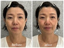 ルー ハナレ 神戸岡本 摂津本山店(Luu HANARE)/小顔 フェイスライン たるみ改善