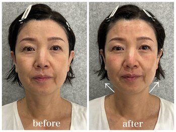 ルー ハナレ 神戸岡本 摂津本山店(Luu HANARE)/小顔 フェイスライン たるみ改善