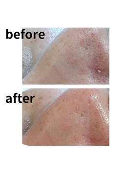 オスマンティエ(Osmantier)/毛穴洗浄ハイドロスプラッシュ