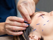 穴田鍼灸整骨院/電気美容鍼