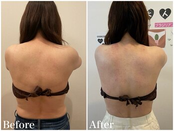 サロンドフェイス(Salon de Faith)/【ブライダル】半年施術♪