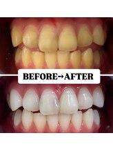 ホワイトニングサロン 豊中/Before&After美白ホワイトニング