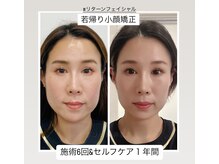 真美(Sinbi)の雰囲気（施術ペース／2週間に1回。セルフケア朝晩2回のビフォーアフター!）
