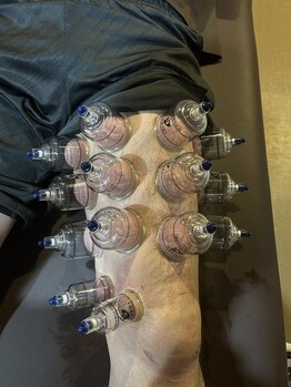 柔整 おがわ屋/カッピング