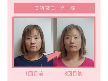 グリーンノア鍼灸院/50代女性美容鍼1-3回目の変化