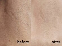 脇の黒ずみケア ローマピンク