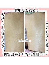 サロンシャイン(Salon Shine)/背中のケア