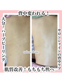 サロンシャイン(Salon Shine)/背中のケア