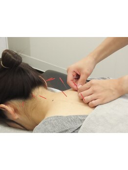 鍼灸施術を受けたい