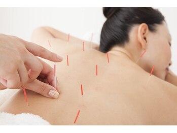 そね健康整骨院/【鍼灸】体の疲れやコリに！