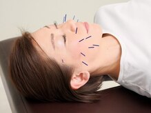 トータルトリートメント優鍼灸院の雰囲気（たるみ、むくみなどが気になる方に【美容鍼】）