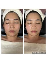 BBC 田園調布/小顔コルギ効果