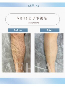 エアリアル 武雄店/ヒザ下脱毛
