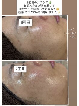 ココ(COCO)/シミケア、ビフォー、アフター