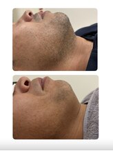 ナルフロウ(nalufurou)/ヒゲ脱毛 &nbsp;&nbsp;&nbsp;