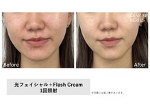 イル 名取店(iru)/プラズマフェイシャル