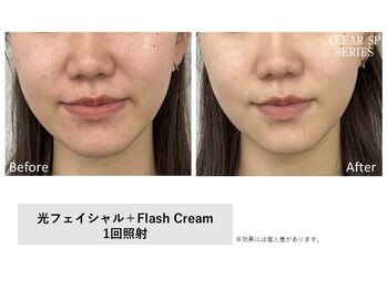 イル 名取店(iru)/プラズマフェイシャル