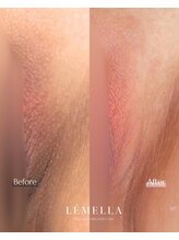 エルビービュティーサロン(LB BEAUTY SALON)/【ルメラ乳輪】実績数関西1★