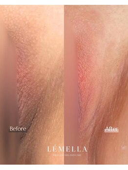 エルビービュティーサロン(LB BEAUTY SALON)/【ルメラ乳輪】実績数関西1★