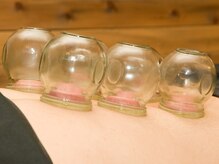 上毛鍼灸院/吸角【カッピング】