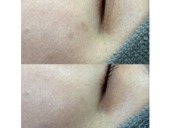 フェアリー/最強!集中シミケア★