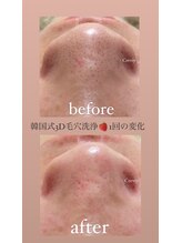 クレヴィー(Creviy)/韓国式3D毛穴洗浄(初回1回目)