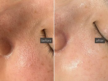 SEC(Shizuoka esthetic company)/【小鼻】ザラつき、ごわつき