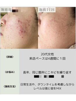 サロンエヌ 久留米店(Salon N)/跡・美白ケア