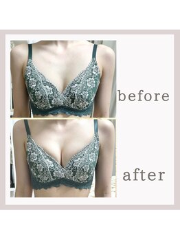 アリサナ(Arisana)/症例写真　バスト　葛西