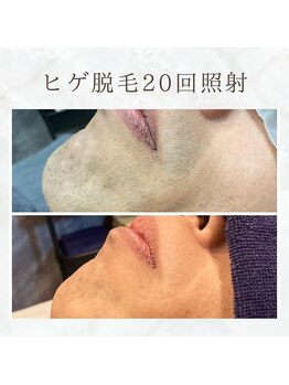 ボゴス(BOGOSS)/ヒゲ20回照射