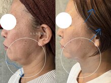 セレブリボーン 大阪ボーテ/ヒト幹細胞/エイジングケア