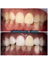 ホワイトニングショップ 武蔵小杉店/武蔵小杉ホワイトニング美白ケア