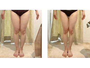 ラグラン銀座メディカルエステ 高輪ゲートウェイ店/ムチムチな脚をどうにかしたい!