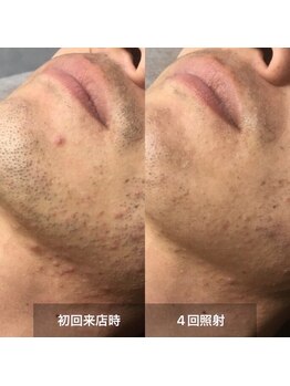 リムル(REMURU)/ひげ脱毛4回照射