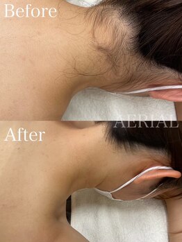 エアリアル 武雄店/えりあし脱毛で見え方激変!