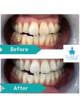 ティンクルホワイト 上尾店/ホワイトニングBefore After
