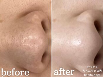 ボニータアンジュ 恵比寿(Bonita Ange)/恵比寿ハーブピーリング｜症例