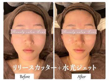 リノ(Lino)/リリースカッター×水光ジェット