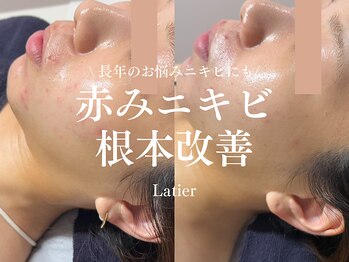 ラティエ(Latier)/ニキビ根本改善ハーブピーリング