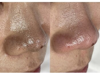 アネモネ(ANEMONE)/韓国式3D毛穴洗浄