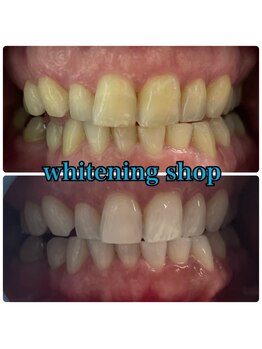 ホワイトニングショップ 武蔵小杉店/武蔵小杉ホワイトニング美白ケア