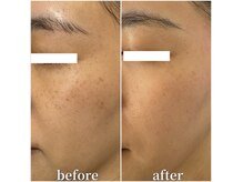 セリー(Celie)の雰囲気（取ってもまた出てきた？シミを徹底改善する方法をお伝えします。）