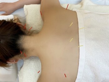 フリージア(Freesia)の写真/【Freesiaオススメの優しいハリ】歴14年のベテラン女性鍼灸師による全身施術。不調を改善してスッキリ◎