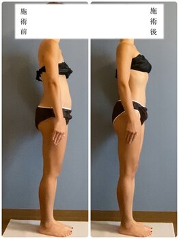 肌音色/■お腹・脂肪燃焼施術例 40代~