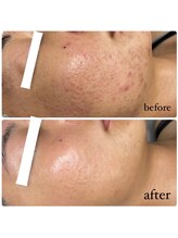 スムー 金沢小橋町店(Smoo)/ハーブピーリング