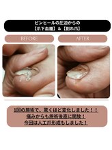 シーエスネイル 元住吉店(CS NAIL)/【巻き爪補正】