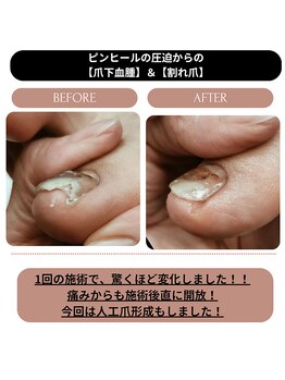 シーエスネイル 元住吉店(CS NAIL)/【巻き爪補正】